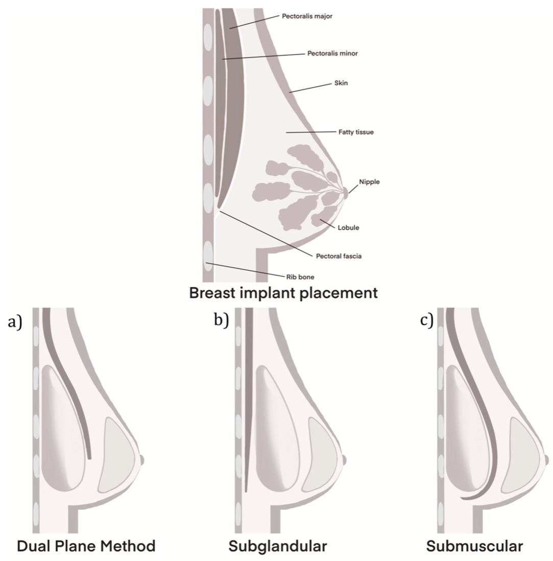 Anatomia sânului și cele trei planuri de plasare a implantului mamar: dual plane, subglandular deasupra mușchiului pectoral și submuscular sub mușchi