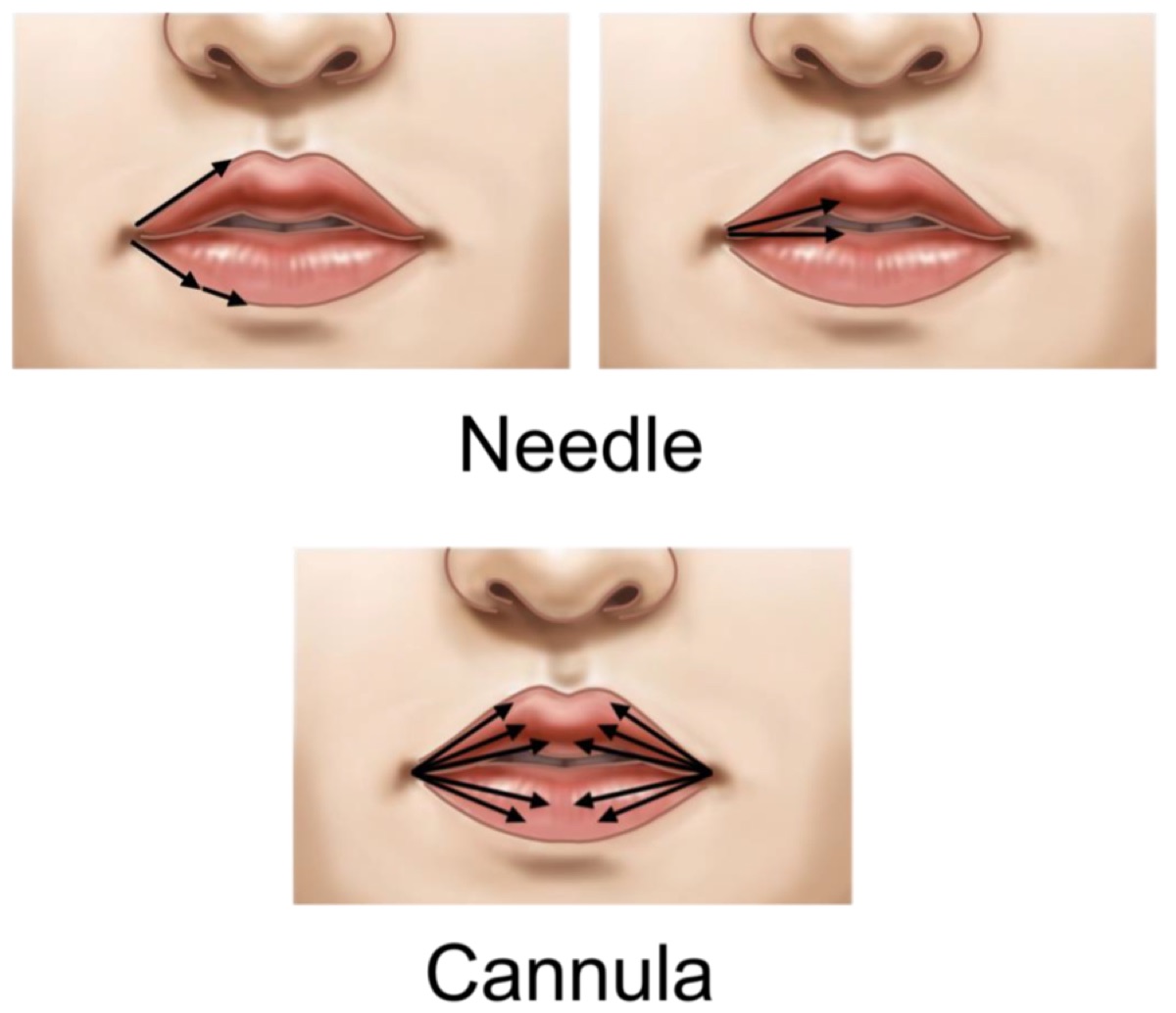 Tehnici de injectare la buze: cu acul, pornind din colțul gurii de-a lungul conturului și al arcului lui Cupidon, și cu canula, cu distribuție în evantai dinspre lateral